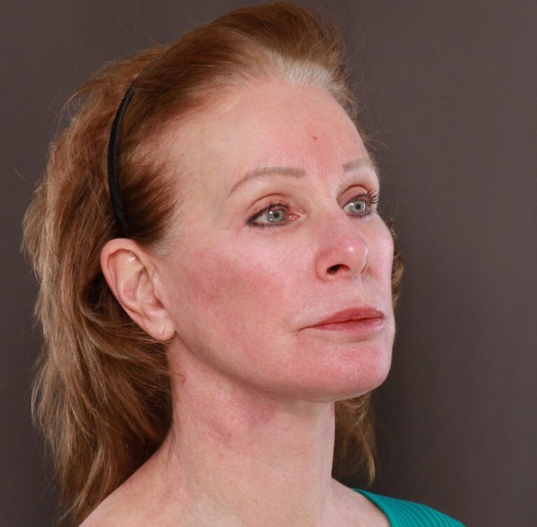 After Image: Facelift, Lower Blepharoplasty with Periorbital Fat Grafting by Dr. Thompson - right-front-oblique
