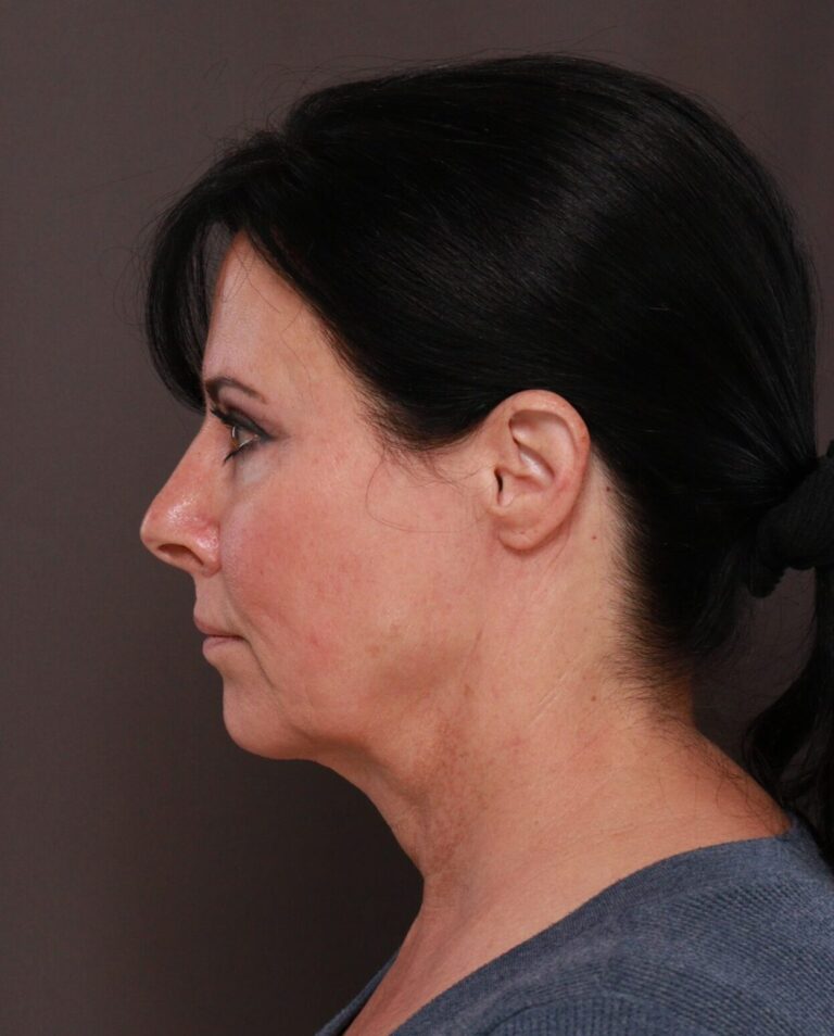 Before Image: Macslift & Deep Neck Contouring by Dr. Manning - left-side