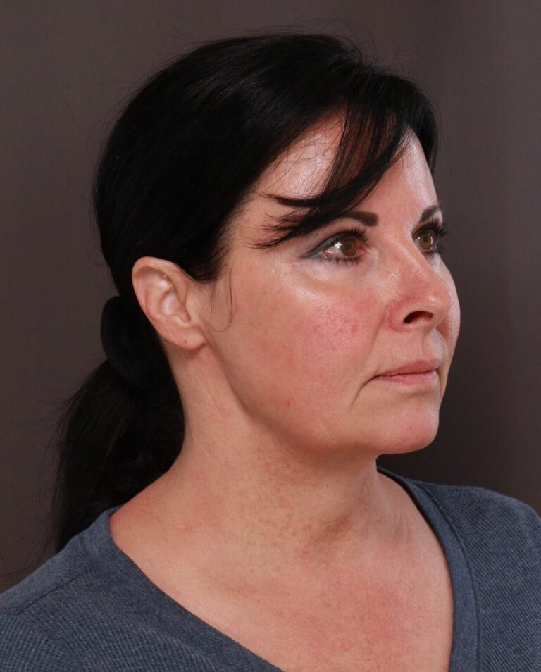 Before Image: Macslift & Deep Neck Contouring by Dr. Manning - right-front-oblique