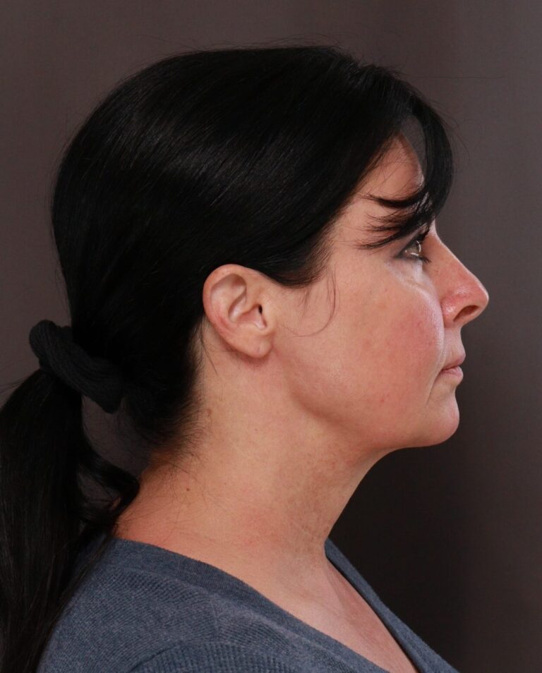 Before Image: Macslift & Deep Neck Contouring by Dr. Manning - right-side