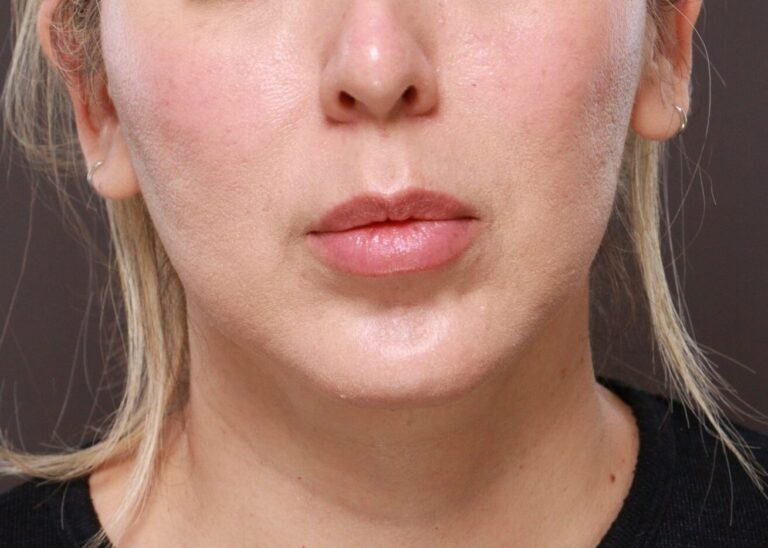 Before Image: Lip Lift by Dr. Thompson - front