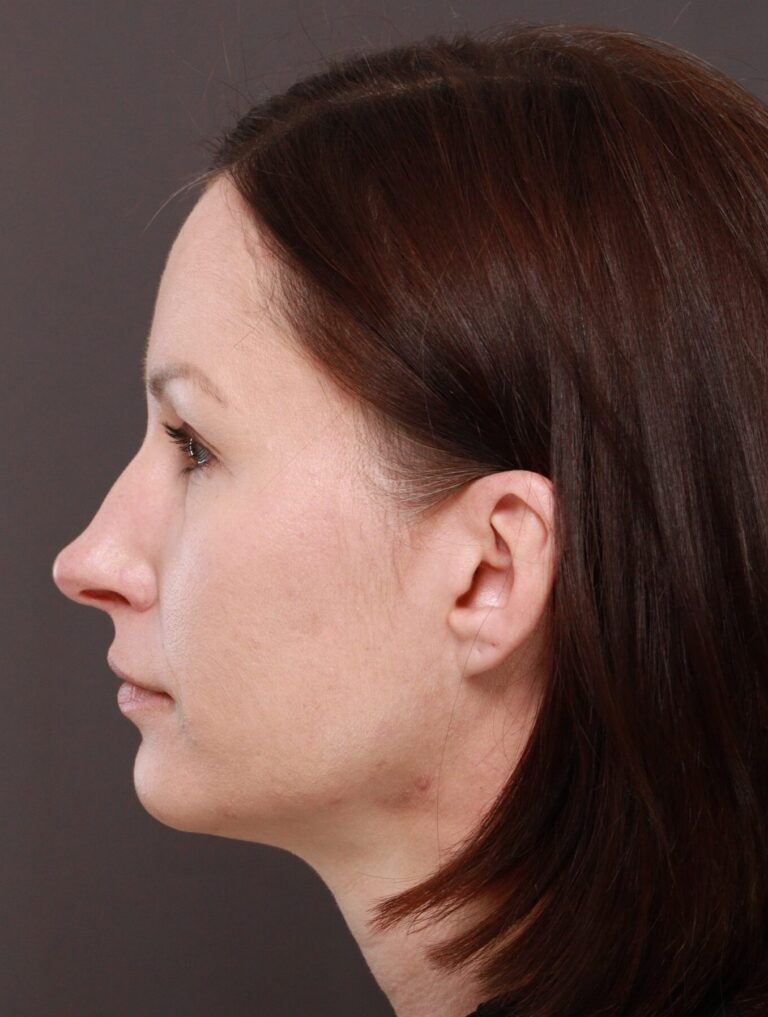 After Image: Browlift by Dr. Manning - left-side