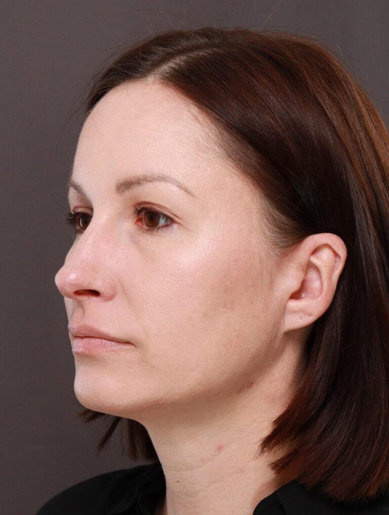 After Image: Browlift by Dr. Manning - left-front-oblique