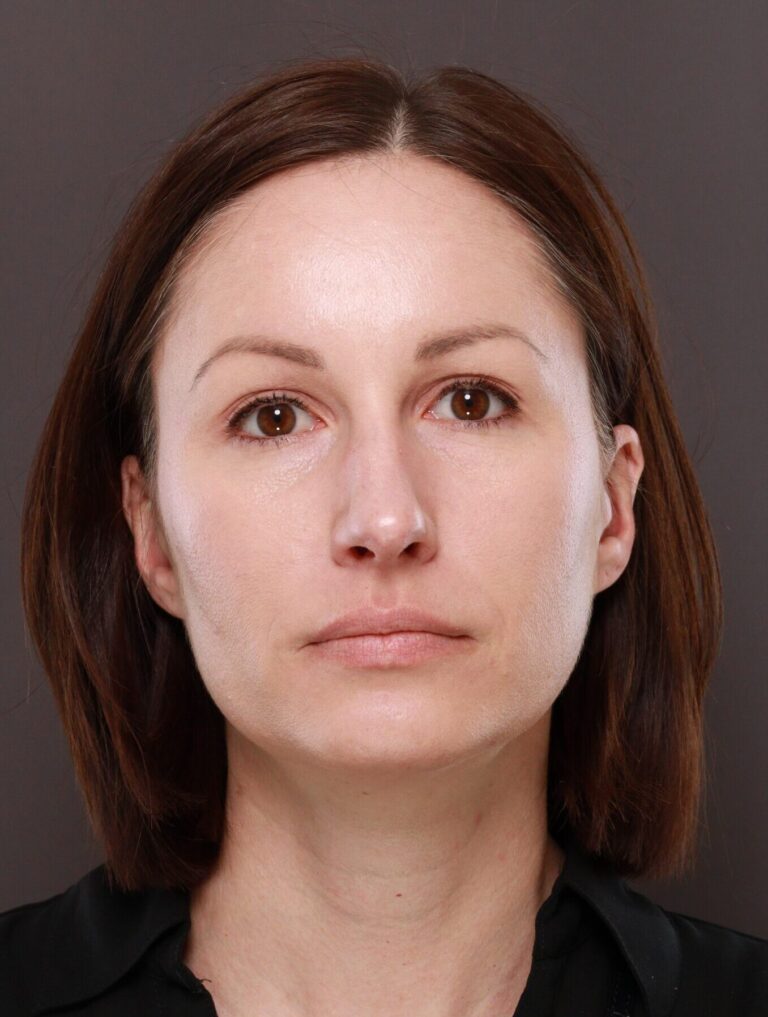 After Image: Browlift by Dr. Manning - front