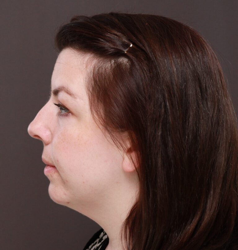 Before Image: Deep Neck Contouring by Dr. Manning - left-side