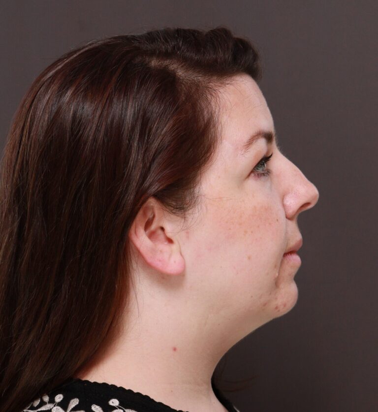 Before Image: Deep Neck Contouring by Dr. Manning - right-side