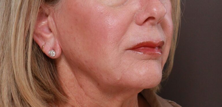 Before Image: Lip Lift by Dr. Henstrom - right-front-oblique