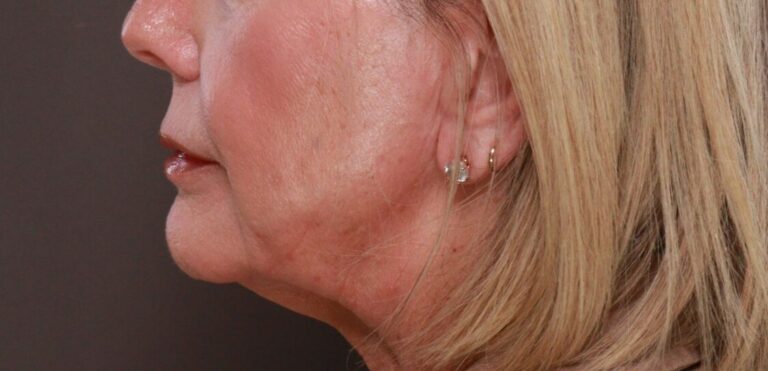 Before Image: Lip Lift by Dr. Henstrom - left-side