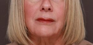 Before Image: Lip Lift by Dr. Henstrom