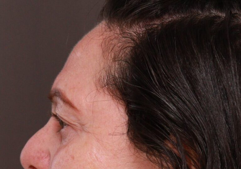 Before Image: Upper Blepharoplasty by Dr. Henstrom - left-side