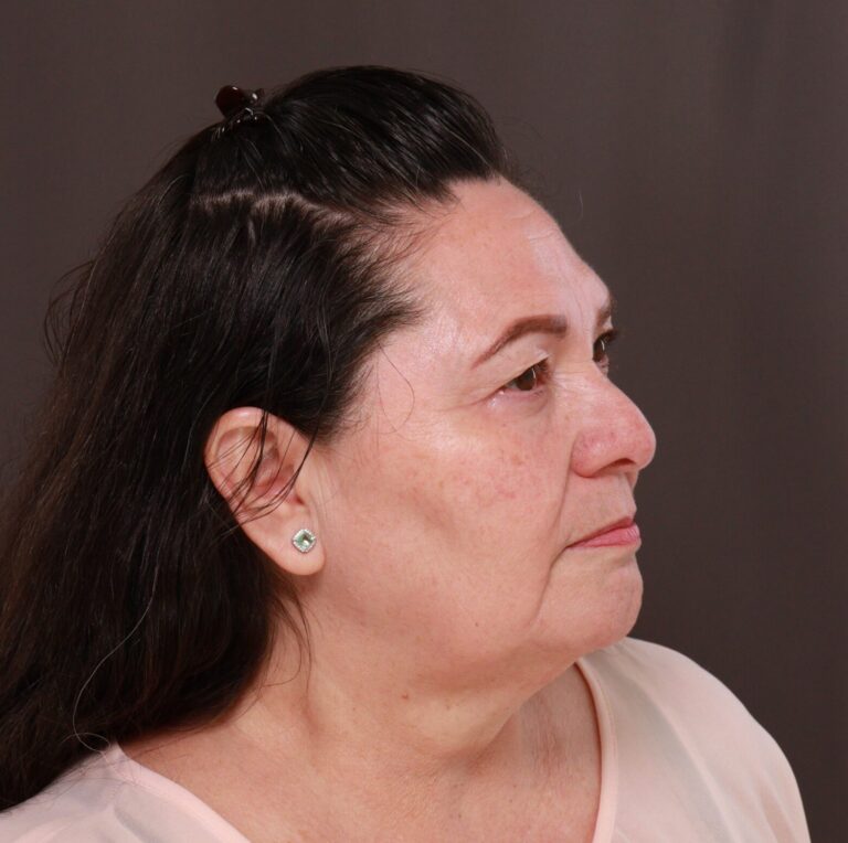 Before Image: Upper Blepharoplasty by Dr. Henstrom - right-front-oblique