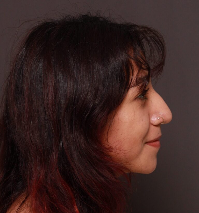 Before Image: Rhinoplasty by Dr. Manning - right-side