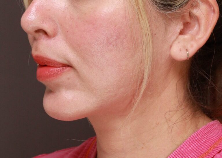 After Image: Lip Lift by Dr. Thompson - left-front-oblique