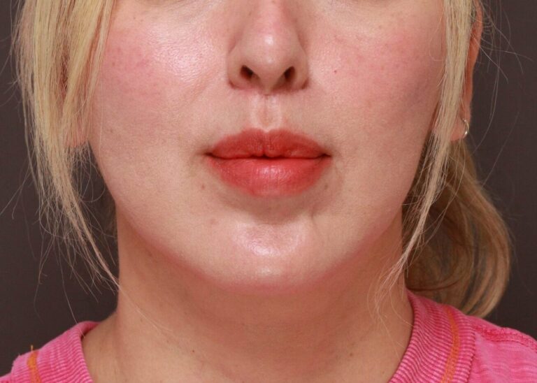 After Image: Lip Lift by Dr. Thompson - front
