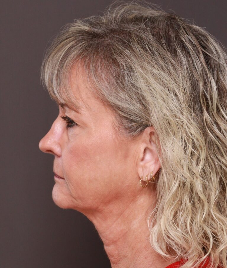 Before Image: Facelift, Upper & Lower Blepharoplasty by Dr. Henstrom - left-side
