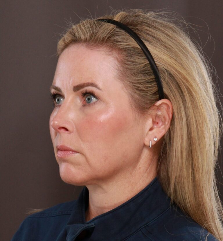 After Image: Moxi & BBL (Broad Band Light) - left-front-oblique