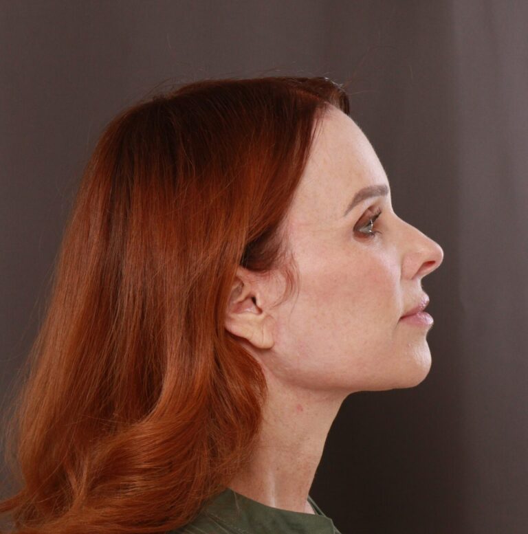After Image: Facelift, Forehead Reduction, & Upper Blepharoplasty by Dr. Thompson - right-side