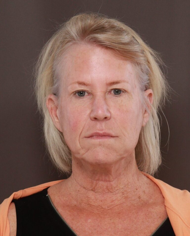 Before Image: Facelift, Upper Blepharoplasty, & Contour TRL by Dr. Manning - front