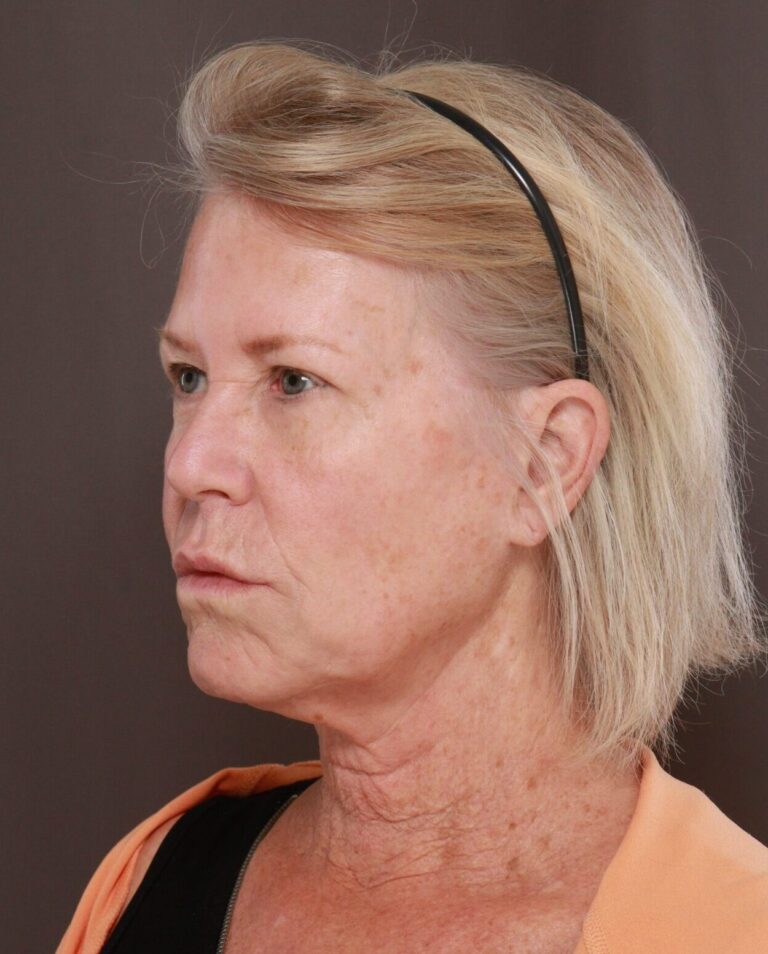 Before Image: Facelift, Upper Blepharoplasty, & Contour TRL by Dr. Manning - left-front-oblique