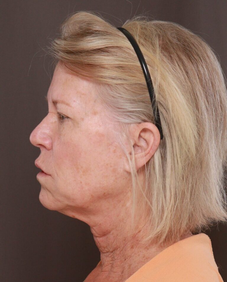 Before Image: Facelift, Upper Blepharoplasty, & Contour TRL by Dr. Manning - left-side