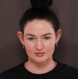 Before Image: Otoplasty by Dr. Henstrom