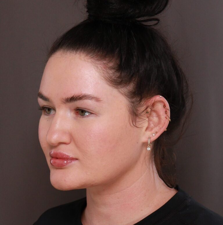 Before Image: Otoplasty by Dr. Henstrom - right-front-oblique