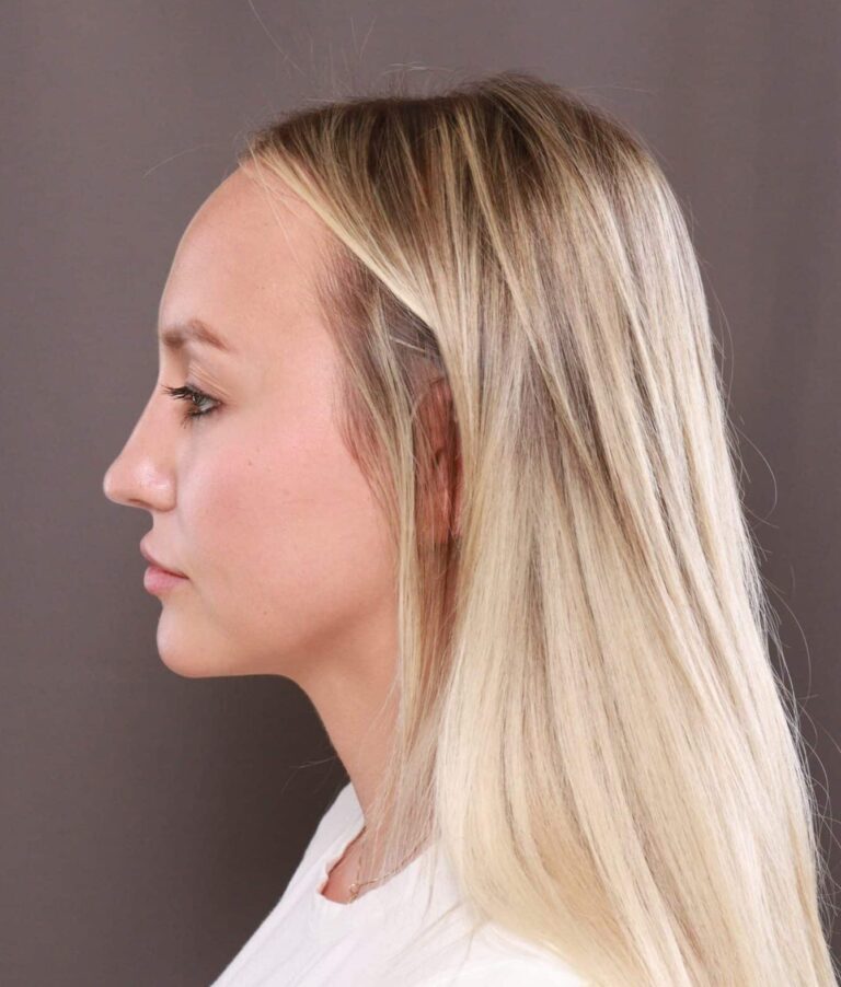 Before Image: Forehead Reduction by Dr. Thompson - left-side