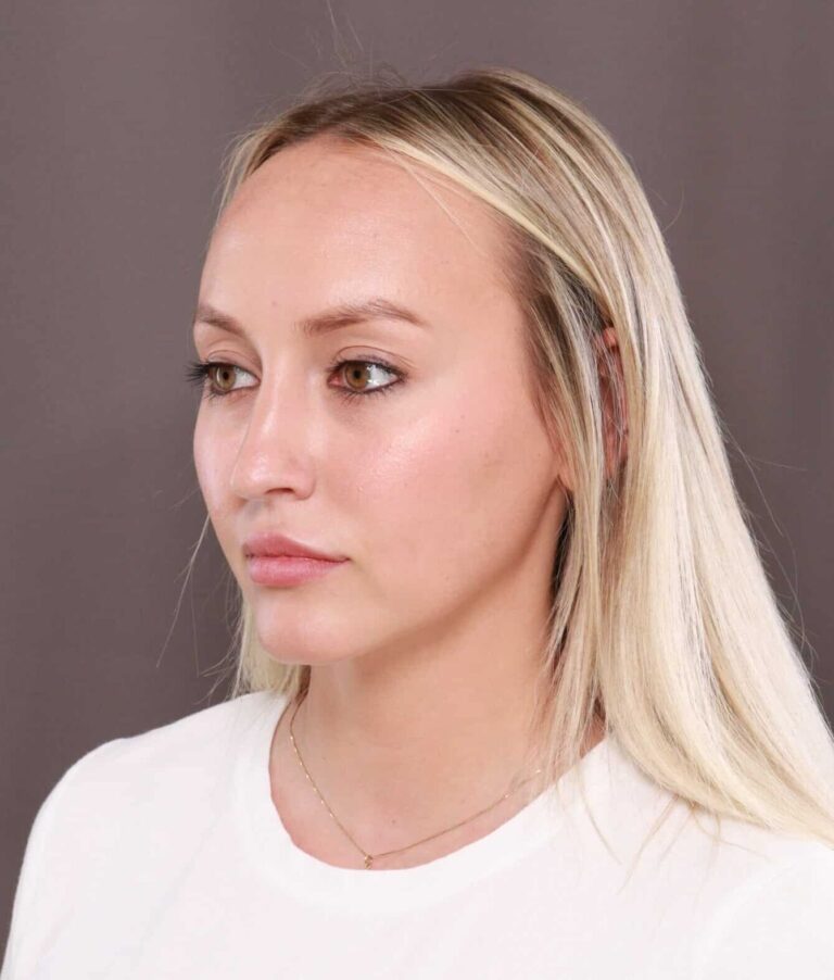Before Image: Forehead Reduction by Dr. Thompson - left-front-oblique