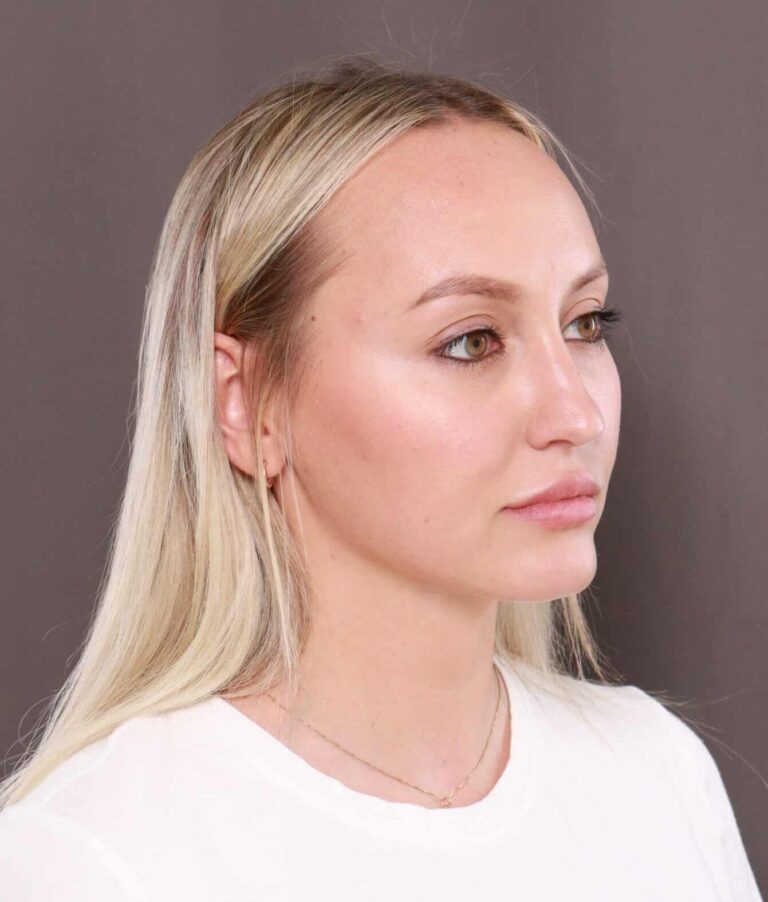 Before Image: Forehead Reduction by Dr. Thompson - right-front-oblique