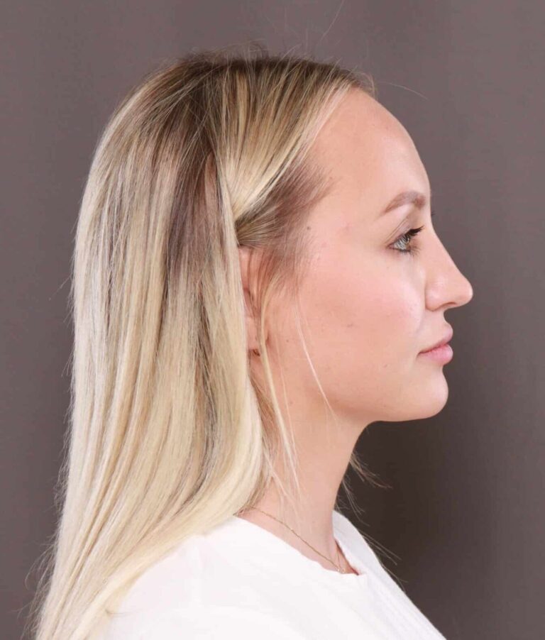 Before Image: Forehead Reduction by Dr. Thompson - right-side