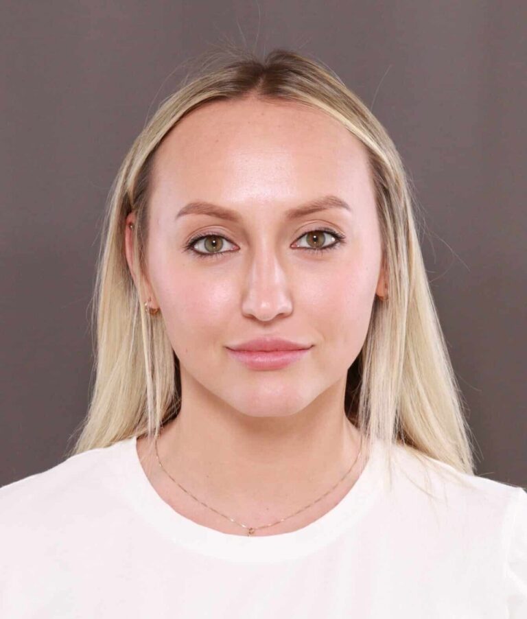 Before Image: Forehead Reduction by Dr. Thompson - front