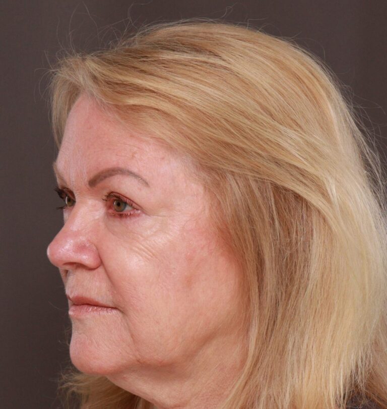After Image: Upper Blepharoplasty by Dr. Manning - left-front-oblique