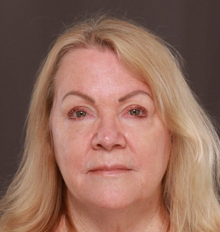 After Image: Upper Blepharoplasty by Dr. Manning - front