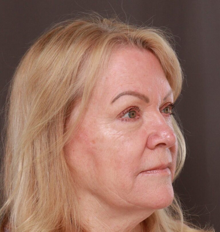 After Image: Upper Blepharoplasty by Dr. Manning - right-front-oblique