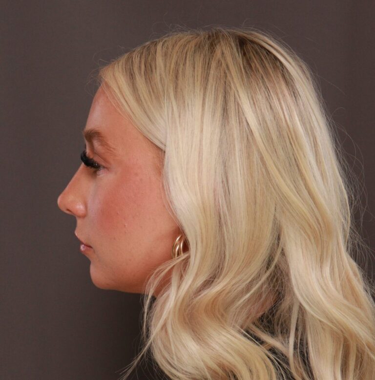 After Image: Rhinoplasty by Dr. Henstrom - left-side