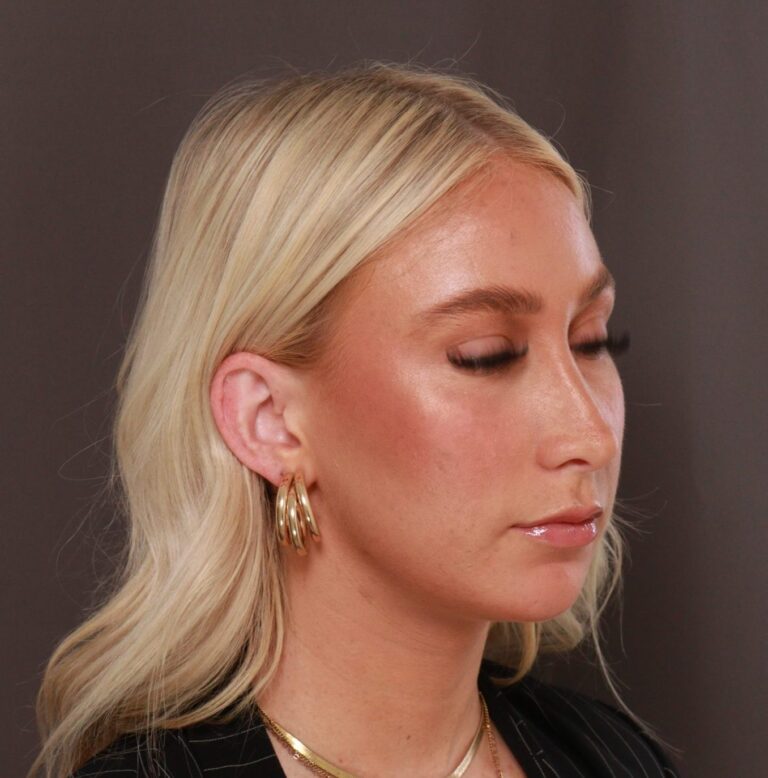 After Image: Rhinoplasty by Dr. Henstrom - right-front-oblique