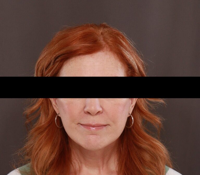After Image: Facelift by Dr. Henstrom - front