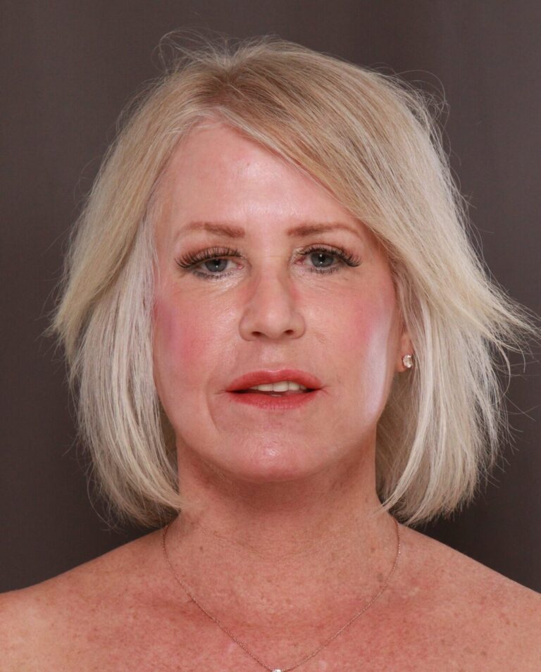 After Image: Facelift, Upper Blepharoplasty, & Contour TRL by Dr. Manning - front