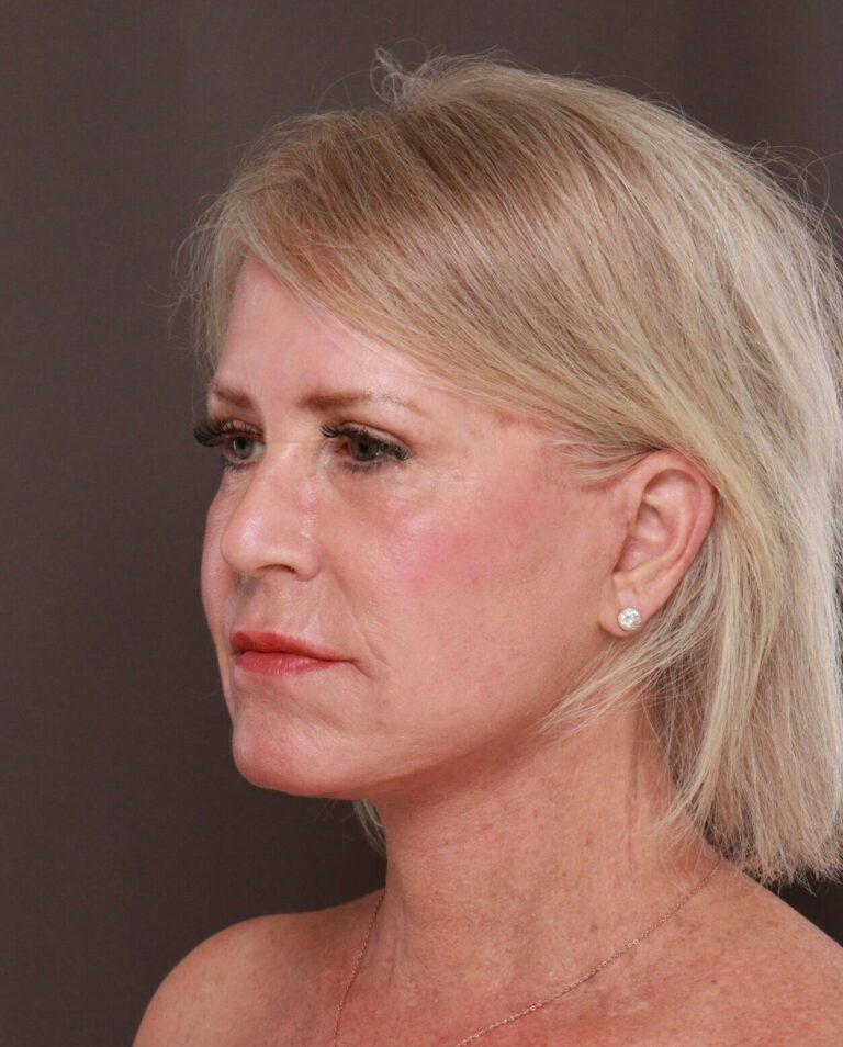 After Image: Facelift, Upper Blepharoplasty, & Contour TRL by Dr. Manning - left-front-oblique
