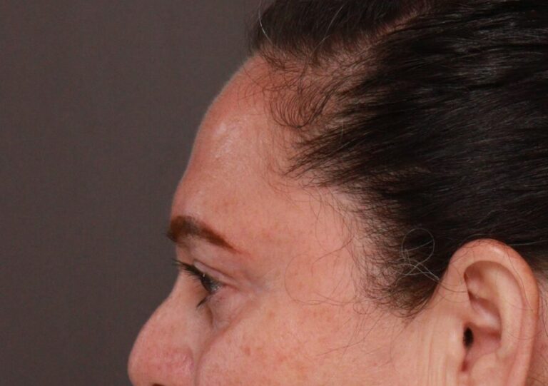 After Image: Upper Blepharoplasty by Dr. Henstrom - left-side