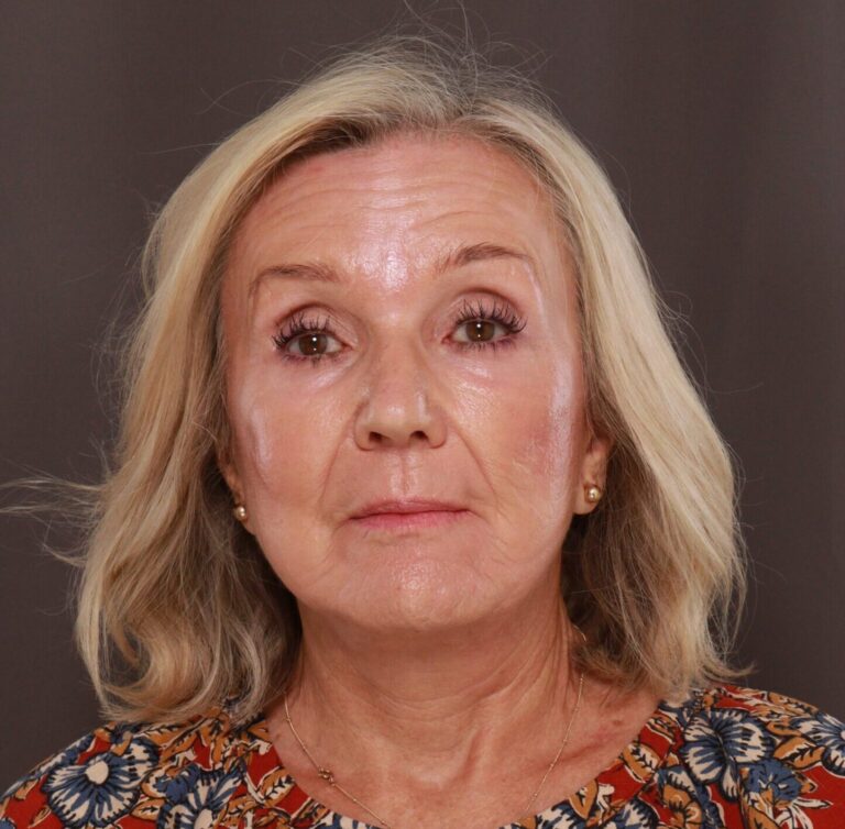 After Image: Facelift and Fat Grafting by Dr. Henstrom and Contour TRL by Katy Larson - front