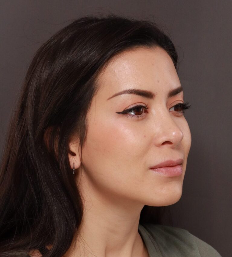 After Image: Rhinoplasty by Dr. Henstrom - right-front-oblique