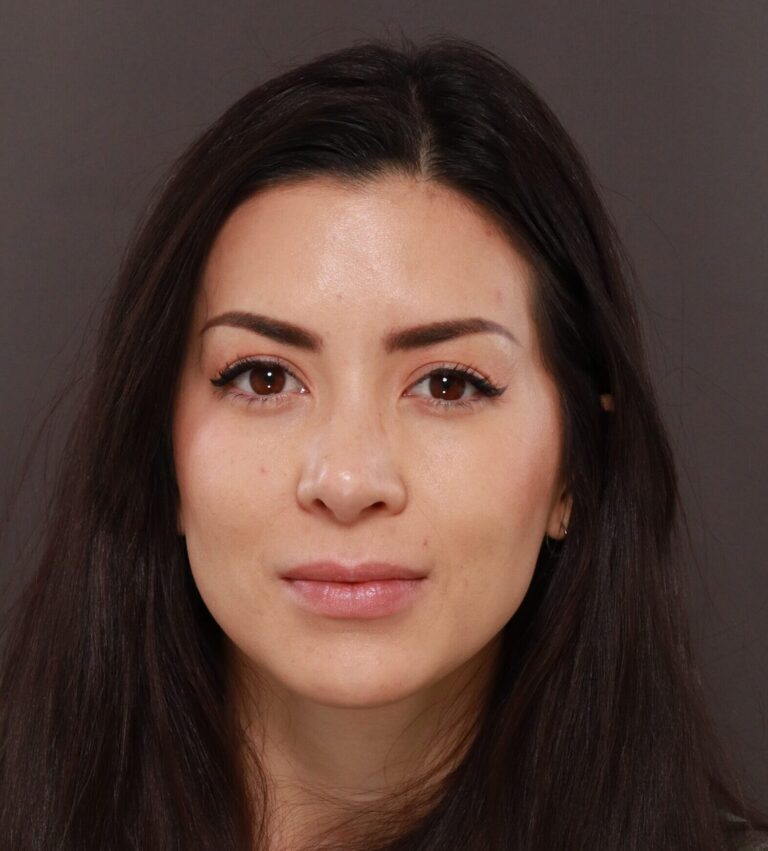 After Image: Rhinoplasty by Dr. Henstrom - front