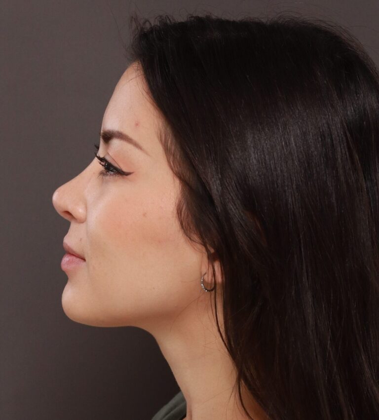 After Image: Rhinoplasty by Dr. Henstrom - left-side