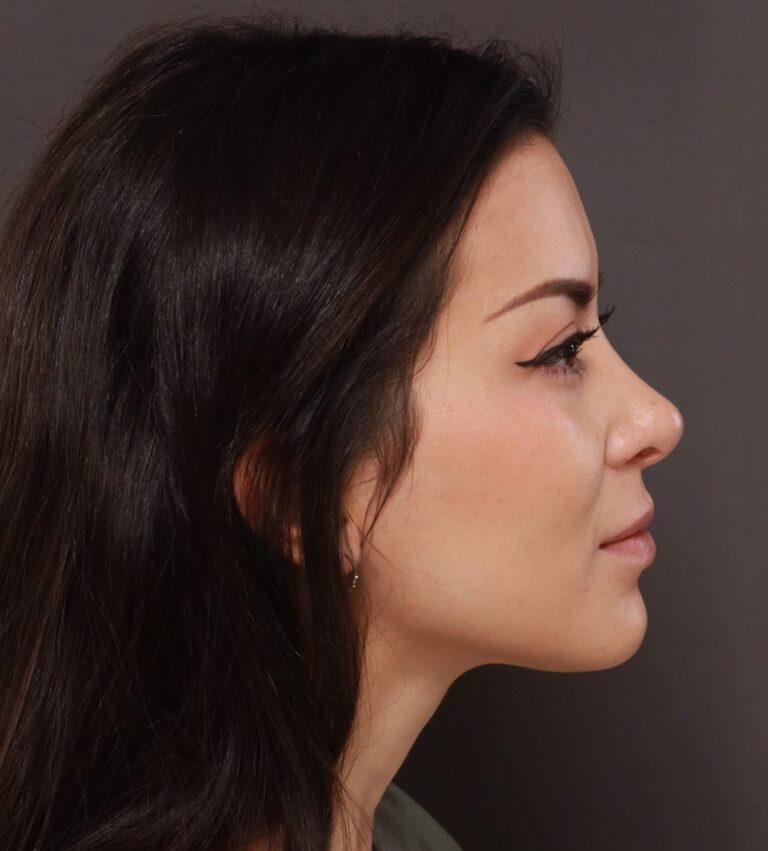 After Image: Rhinoplasty by Dr. Henstrom - right-side