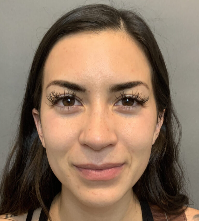 Before Image: Rhinoplasty by Dr. Henstrom - front