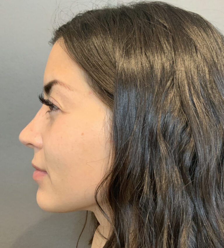 Before Image: Rhinoplasty by Dr. Henstrom - left-side