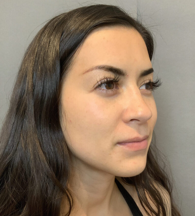 Before Image: Rhinoplasty by Dr. Henstrom - right-front-oblique