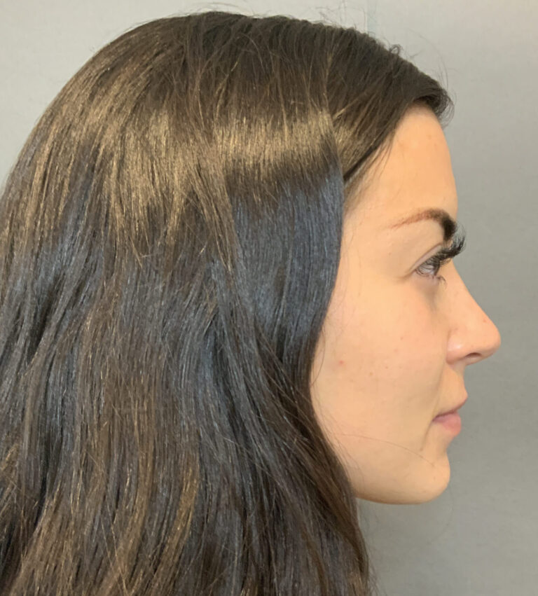 Before Image: Rhinoplasty by Dr. Henstrom - right-side