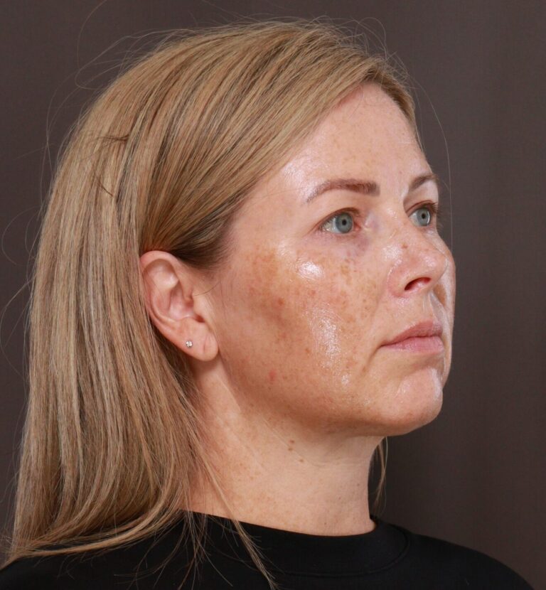 Before Image: Moxi & BBL (Broad Band Light) - right-front-oblique